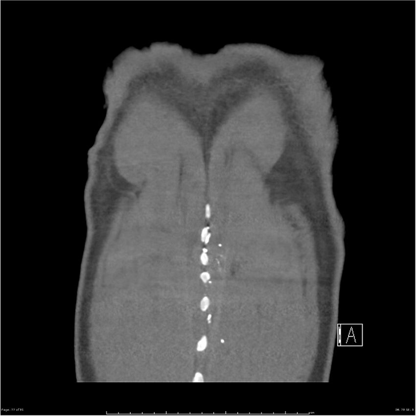 Azygos venous system anatomy (CT pulmonary angiography) (Radiopaedia 25928-26077 Coronal C+ CTPA 77).jpg