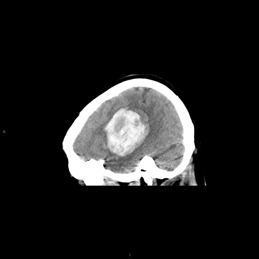 Basal ganglia hemorrhage (Radiopaedia 58349-65472 C 40).jpg