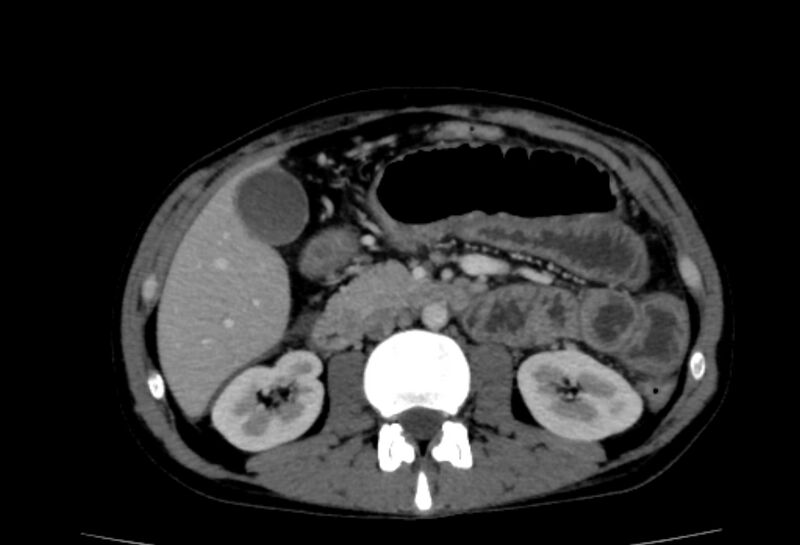 File:Behçet's disease- abdominal vasculitis (Radiopaedia 55955-62570 A 34).jpg