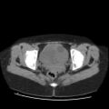 Bicornuate uterus- on MRI (Radiopaedia 49206-54296 Axial non-contrast 11).jpg