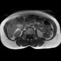 Bicornuate uterus (Radiopaedia 61974-70046 Axial T1 2).jpg