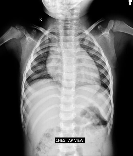File:Bifurcated hypoplastic 4th rib with supernumerary lumbar ribs (Radiopaedia 84651).jpg