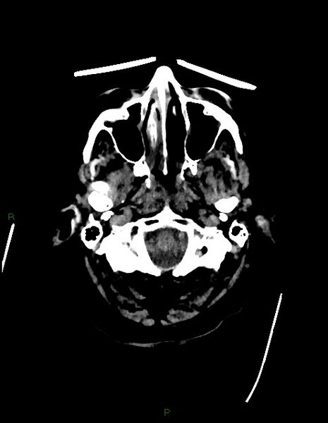 File:Bilateral acute middle cerebral artery territory infarcts (Radiopaedia 77319-89401 Axial non-contrast 6).jpg