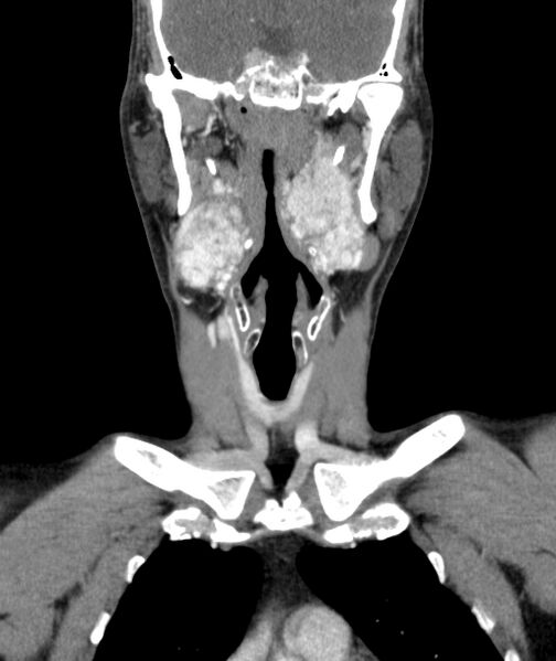 File:Bilateral carotid body tumors (Radiopaedia 52899-58827 B 14).jpg