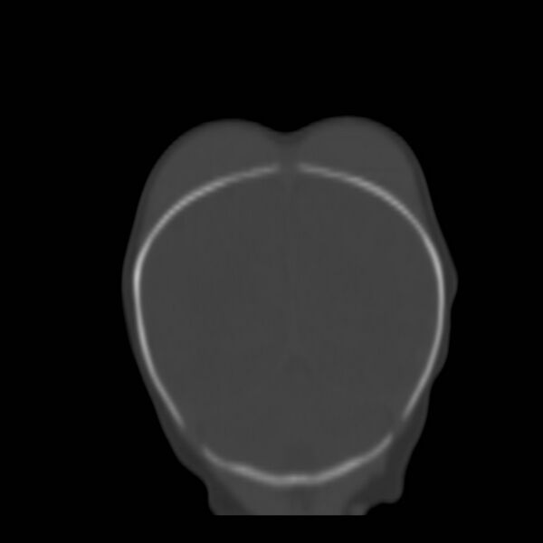 File:Bilateral cephalohematomas and subdural hematomas (Radiopaedia 26778-26929 Coronal bone window 26).jpg