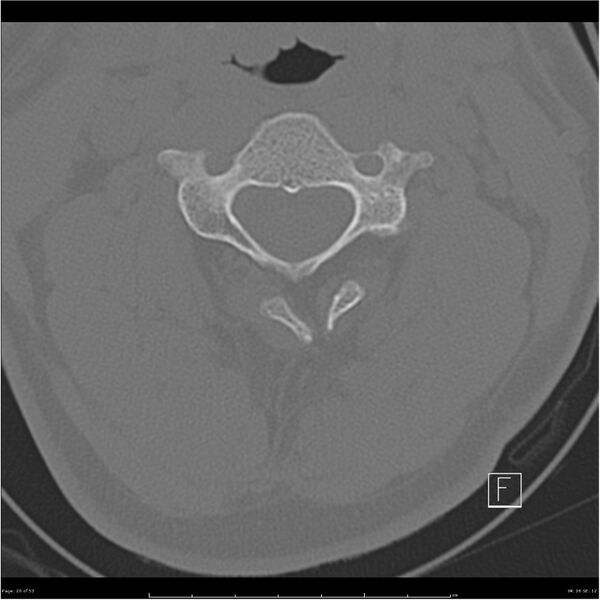 File:Bilateral cervical ribs (Radiopaedia 25868-26017 Axial bone window 20).jpg