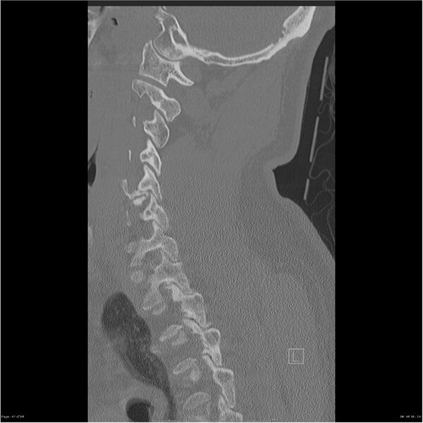 File:Bilateral cervical ribs (Radiopaedia 25868-26017 Sagittal bone window 47).jpg