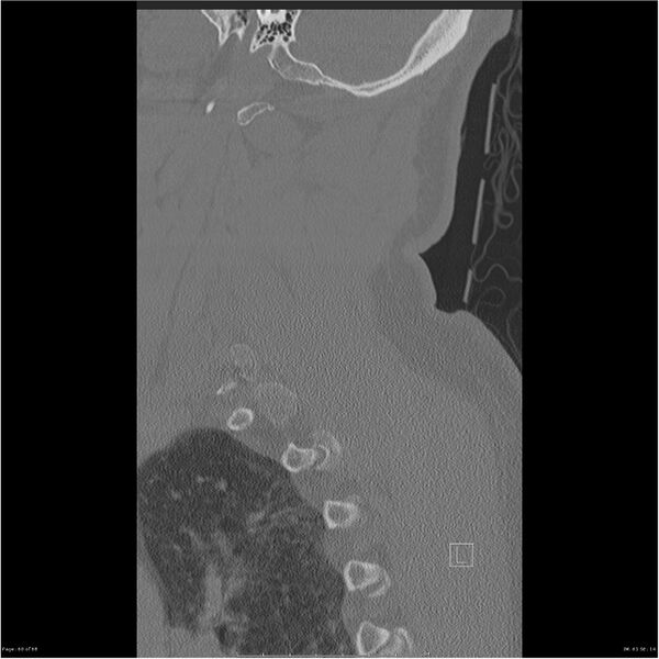File:Bilateral cervical ribs (Radiopaedia 25868-26017 Sagittal bone window 60).jpg