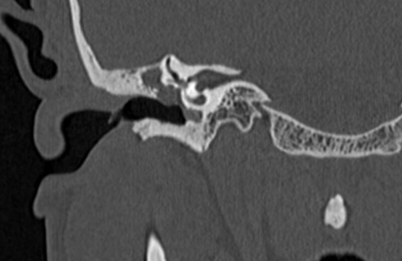 File:Bilateral cholesteatoma (Radiopaedia 54898-61172 Coronal bone window 33).jpg