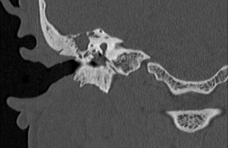 File:Bilateral cholesteatoma (Radiopaedia 54898-61172 Coronal bone window 44).jpg