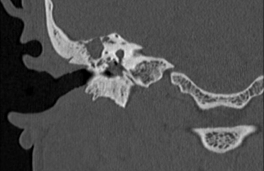 Bilateral cholesteatoma (Radiopaedia 54898-61172 Coronal bone window 44).jpg