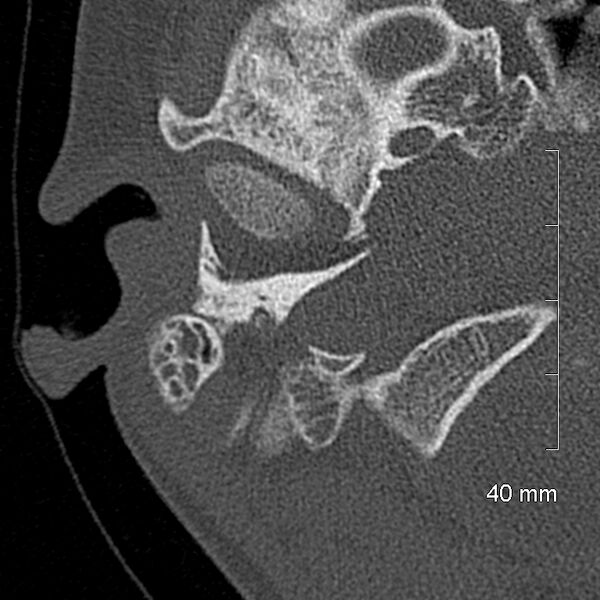 File:Bilateral grommets (Radiopaedia 47710-52404 Axial bone window 12).jpg