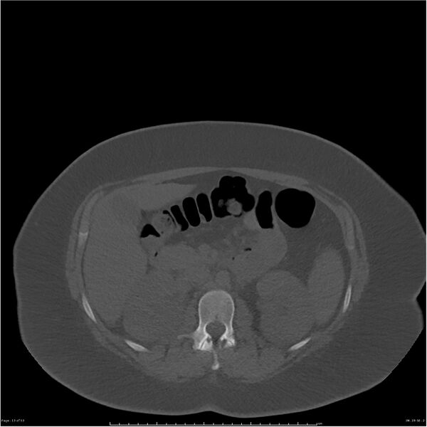 File:Bilateral lumbar ribs (Radiopaedia 25862-26010 bone window 13).jpg
