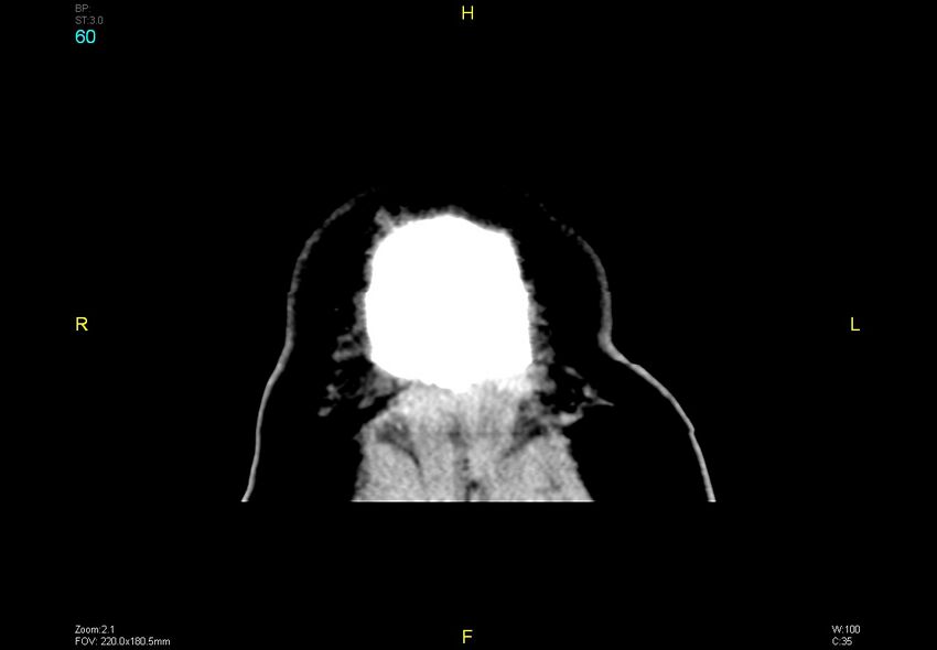 Bilateral medial medullary infarction (Radiopaedia 42220-45295 Coronal non-contrast 60).jpg