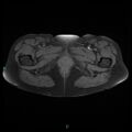 Bilateral ovarian fibroma (Radiopaedia 44568-48293 Axial T1 fat sat 30).jpg