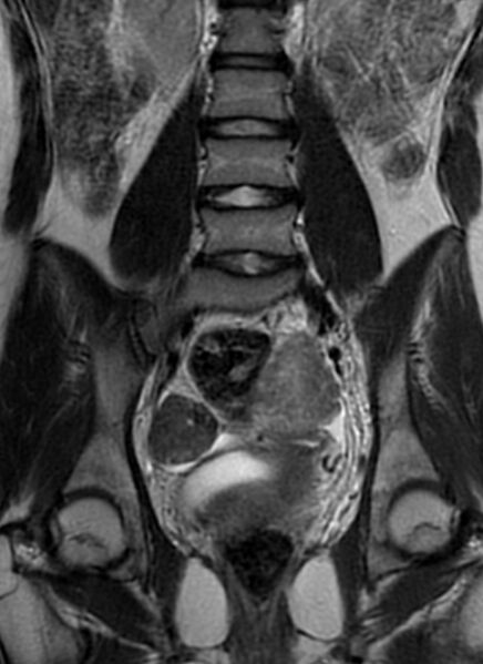 File:Bilateral ovarian fibrothecomas - adolescent (Radiopaedia 86604-102707 Coronal T2 20).jpg
