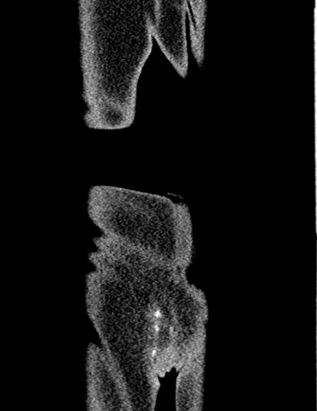 File:Bilateral staghorn calculi (Radiopaedia 59475-66842 Coronal non-contrast 97).jpg