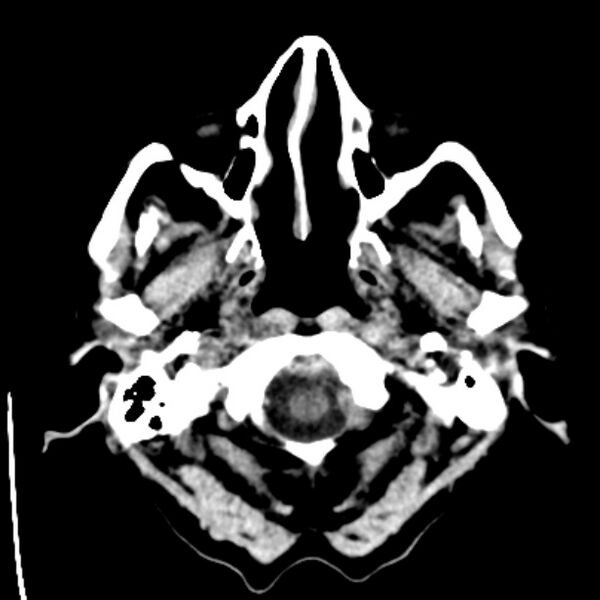 File:Bilateral subdural hygromata (Radiopaedia 29245-29656 Axial non-contrast 2).jpg
