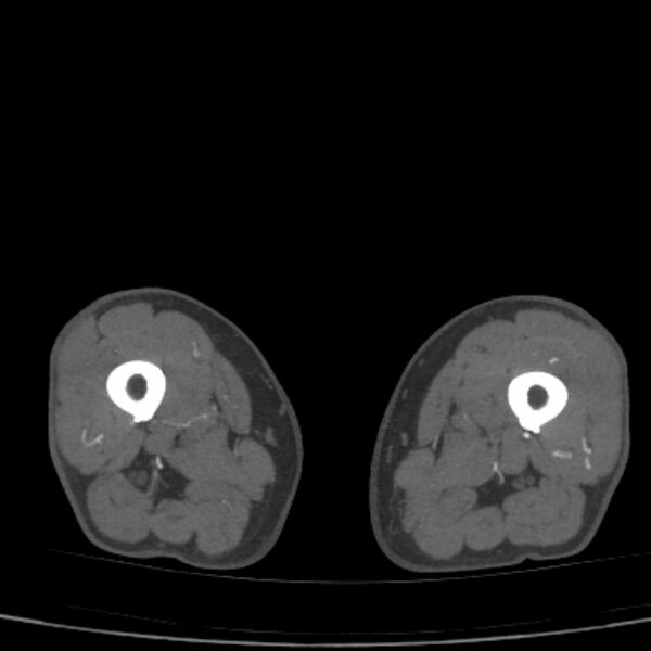 File:Bilateral superficial femoral arterial occlusion (Radiopaedia 25682-25857 A 45).jpg