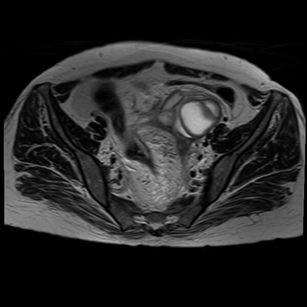 File:Bilateral tubo-ovarian abscesses (Radiopaedia 58635-65829 Axial T2 16).jpg