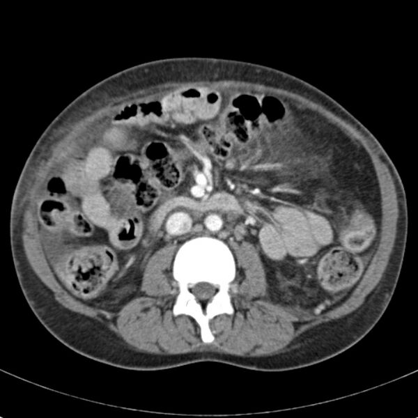 File:Biliary necrosis - liver transplant (Radiopaedia 21876-21846 B 37).jpg