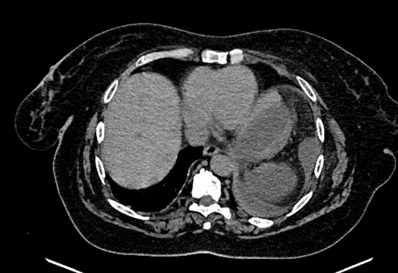 File:Biliary pancreatitis (Radiopaedia 72289-82823 Axial non-contrast 31).jpg