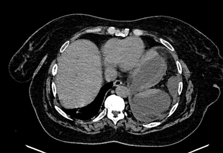 Biliary pancreatitis (Radiopaedia 72289-82823 Axial non-contrast 36).jpg