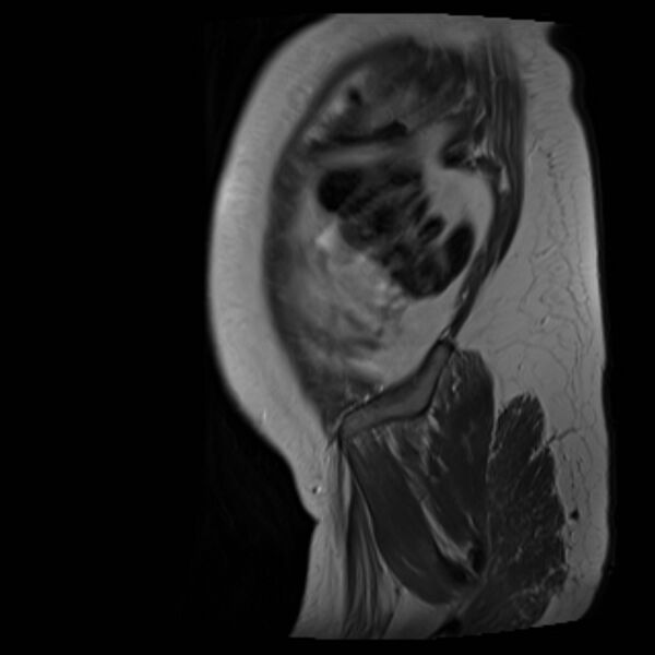 File:Bilobed placenta accreta (Radiopaedia 69648-79591 Sagittal T2 40).jpg