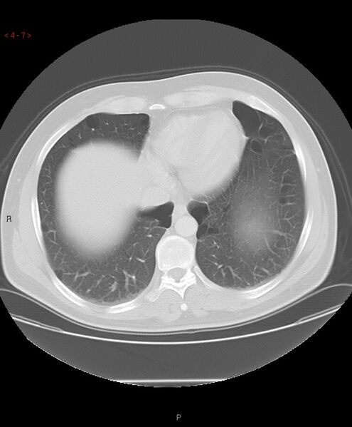 File:Birt-Hogg-Dubé syndrome (Radiopaedia 53814-60013 Axial lung window 7).jpg