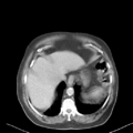Bladder papillary urothelial carcinoma (Radiopaedia 48119-52951 Axial 1).png