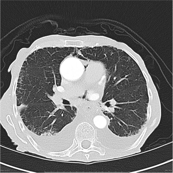 File:Boerhaave syndrome (Radiopaedia 26240-26362 Axial lung window 24).jpg
