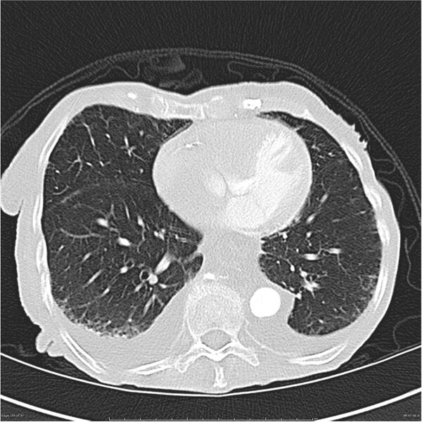 File:Boerhaave syndrome (Radiopaedia 26240-26362 Axial lung window 34).jpg