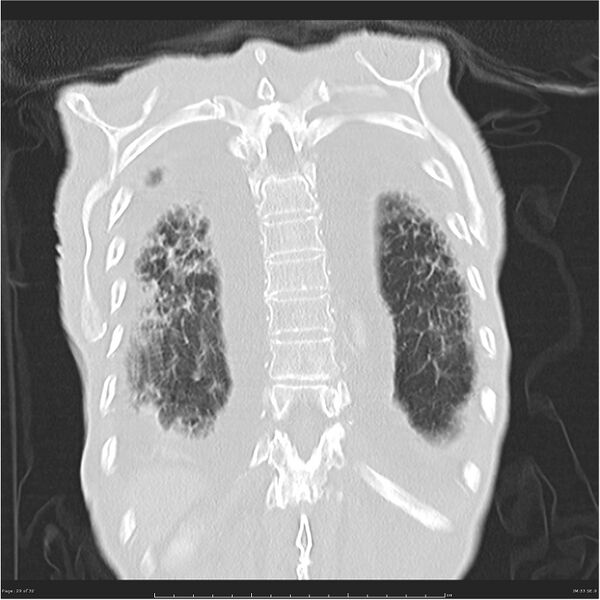File:Boerhaave syndrome (Radiopaedia 26240-26362 Coronal lung window 29).jpg
