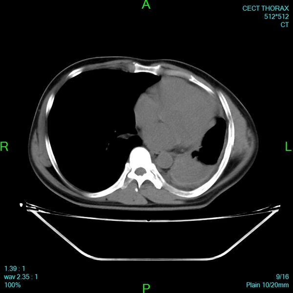 File:Bone metastases from lung carcinoma (Radiopaedia 54703-60937 Axial non-contrast 9).jpg