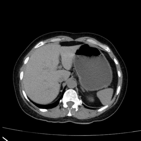 File:Bosniak renal cyst - type I (Radiopaedia 27479-27675 Axial non-contrast 18).jpg