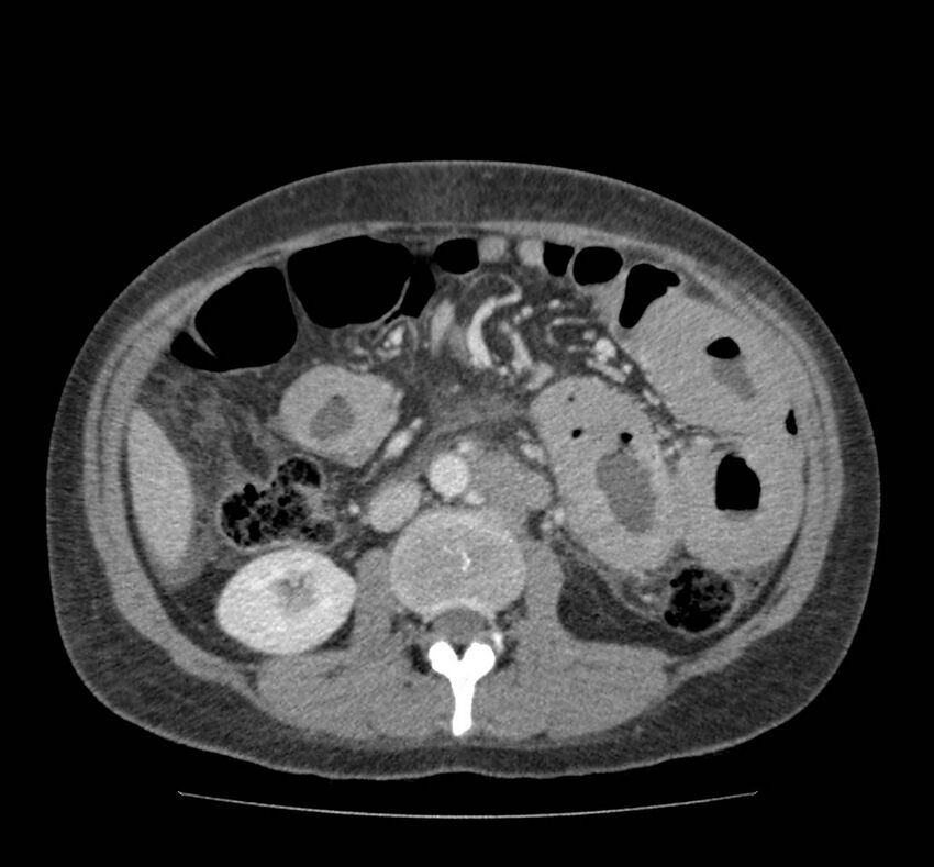 Bowel lymphoma complicated by bleeding after therapy (Radiopaedia 55601-62107 A 40).jpg