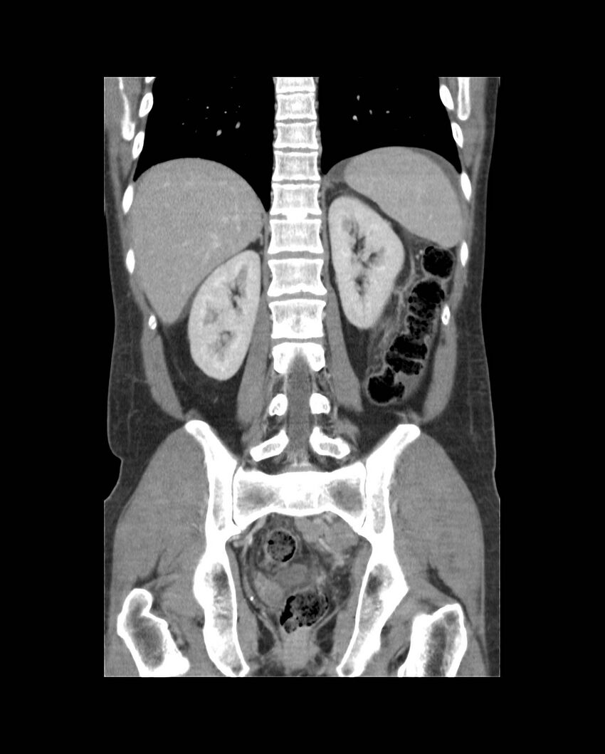 Bowel lymphoma complicated by bleeding after therapy (Radiopaedia 55601-62107 B 47).jpg