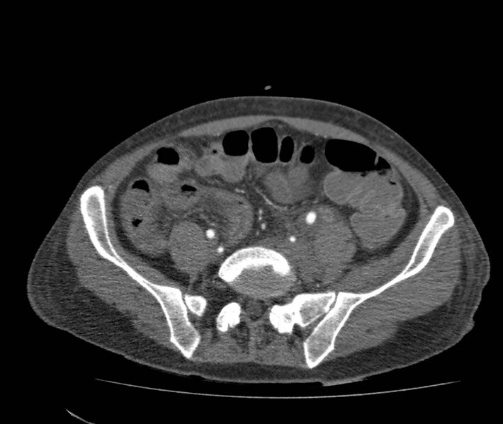 File:Bowel lymphoma complicated by bleeding after therapy (Radiopaedia 55601-62110 B 59).jpg