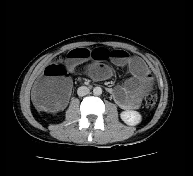 File:Bowel obstruction from colon carcinoma (Radiopaedia 22995-23028 A 41).jpg