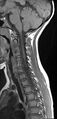 Brachial plexus birth palsy (Radiopaedia 68118-77604 Sagittal T1 6).jpg