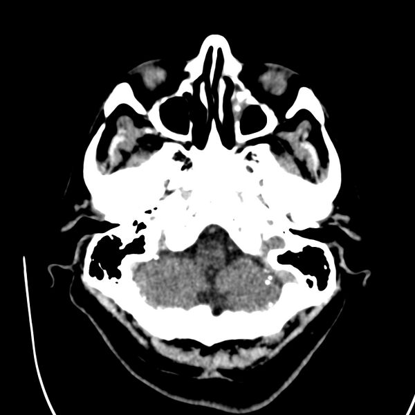 File:Brain Pantopaque remnants (Radiopaedia 78403-91048 Axial non-contrast 23).jpg