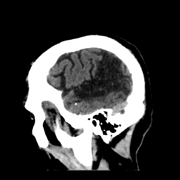 File:Brain Pantopaque remnants (Radiopaedia 78403-91048 C 10).jpg