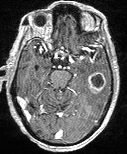 File:Brain abscess with dual rim sign (Radiopaedia 87566-103938 Axial T1 C+ 64).jpg
