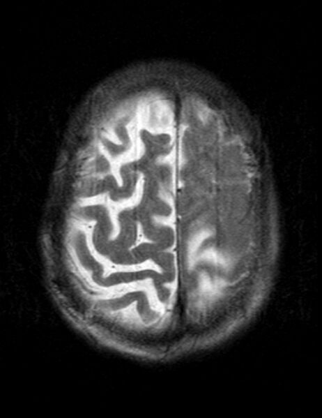 File:Brain abscess with dual rim sign (Radiopaedia 87566-103938 Axial T2 21).jpg