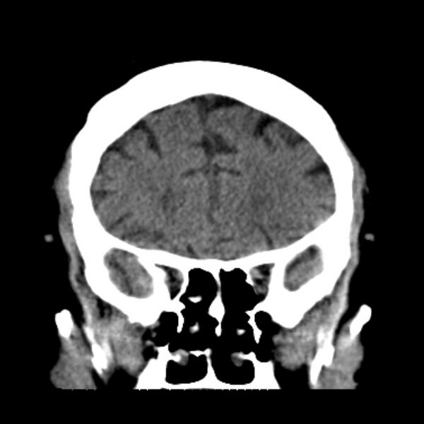 File:Brain cortical laminar necrosis (Radiopaedia 25822-25971 C 16).jpg