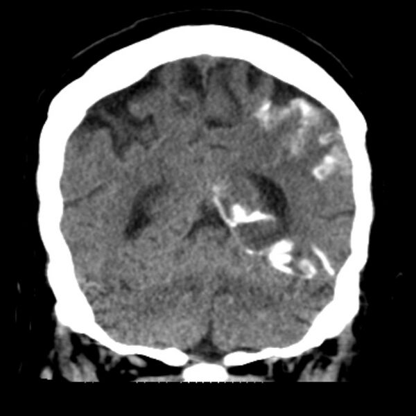 File:Brain cortical laminar necrosis (Radiopaedia 25822-25971 C 40).jpg