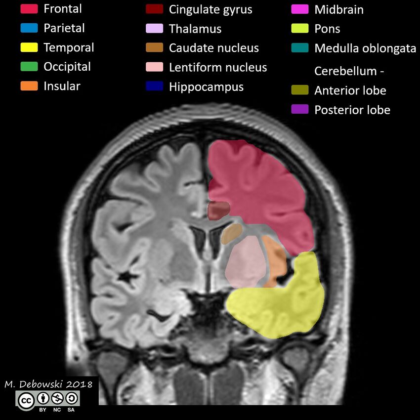 Brain lobes - annotated MRI (Radiopaedia 61691-69700 Coronal 30).JPG