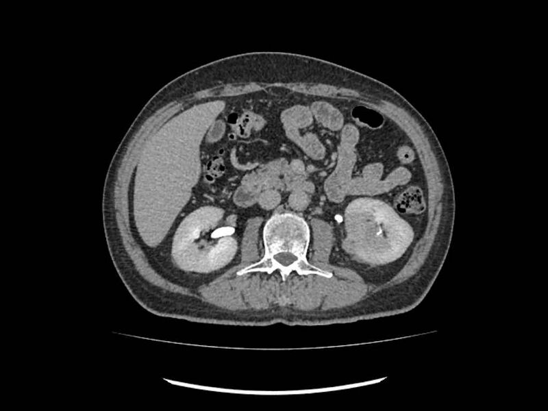 File:Brain metastases from renal cell carcinoma (Radiopaedia 42222-45328 Axial C+ delayed 105).jpg