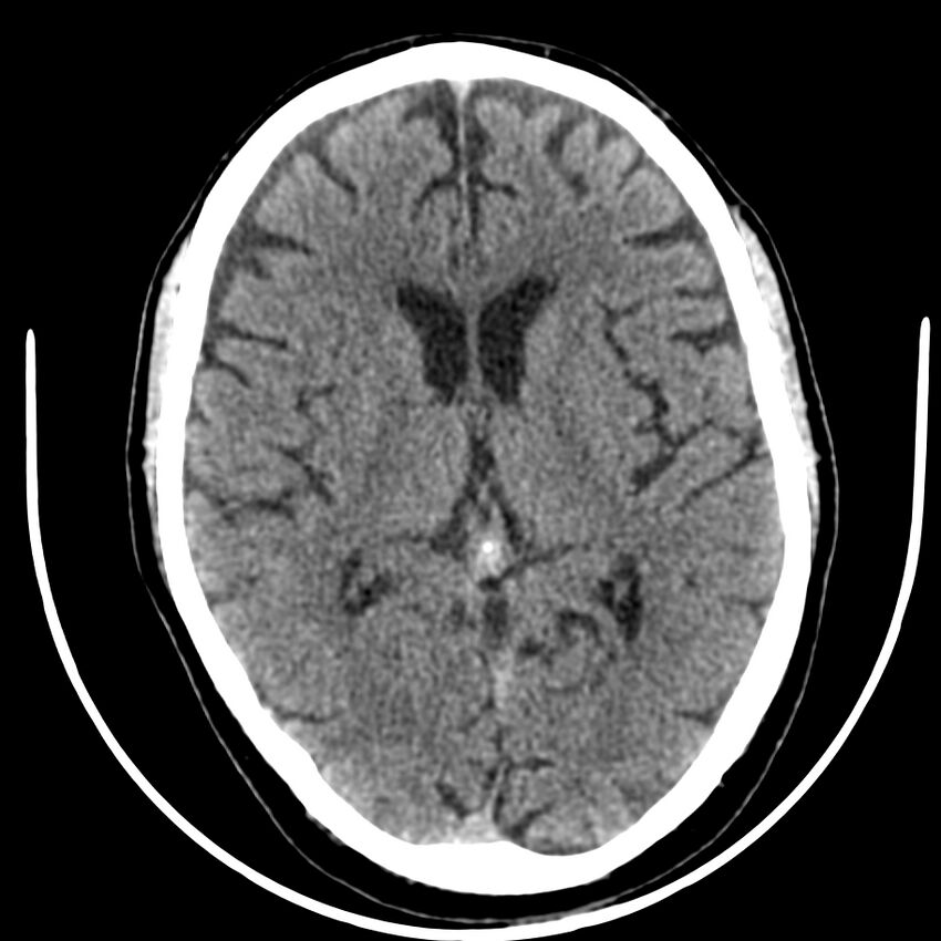 Brain metastasis (Radiopaedia 42617-45760 Axial non-contrast 24).jpg