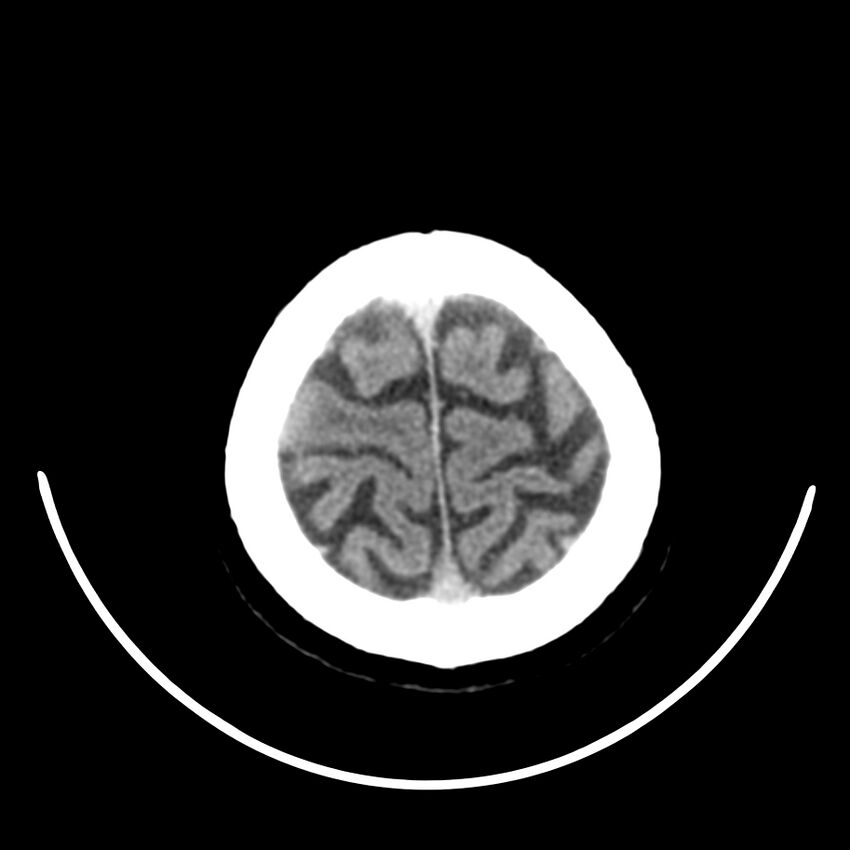 Brain metastasis (Radiopaedia 42617-45760 Axial non-contrast 47).jpg